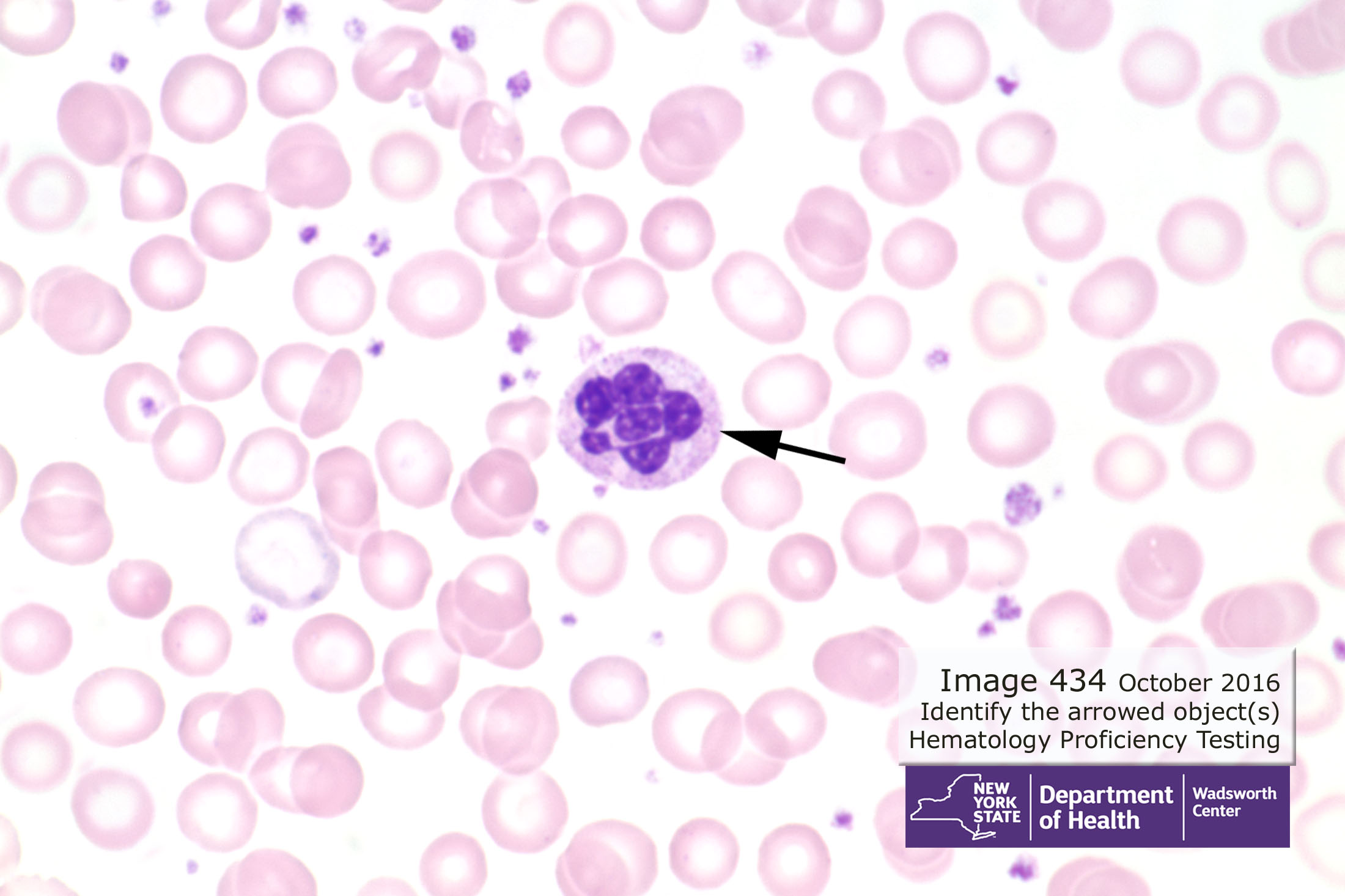 Hematology Image 434