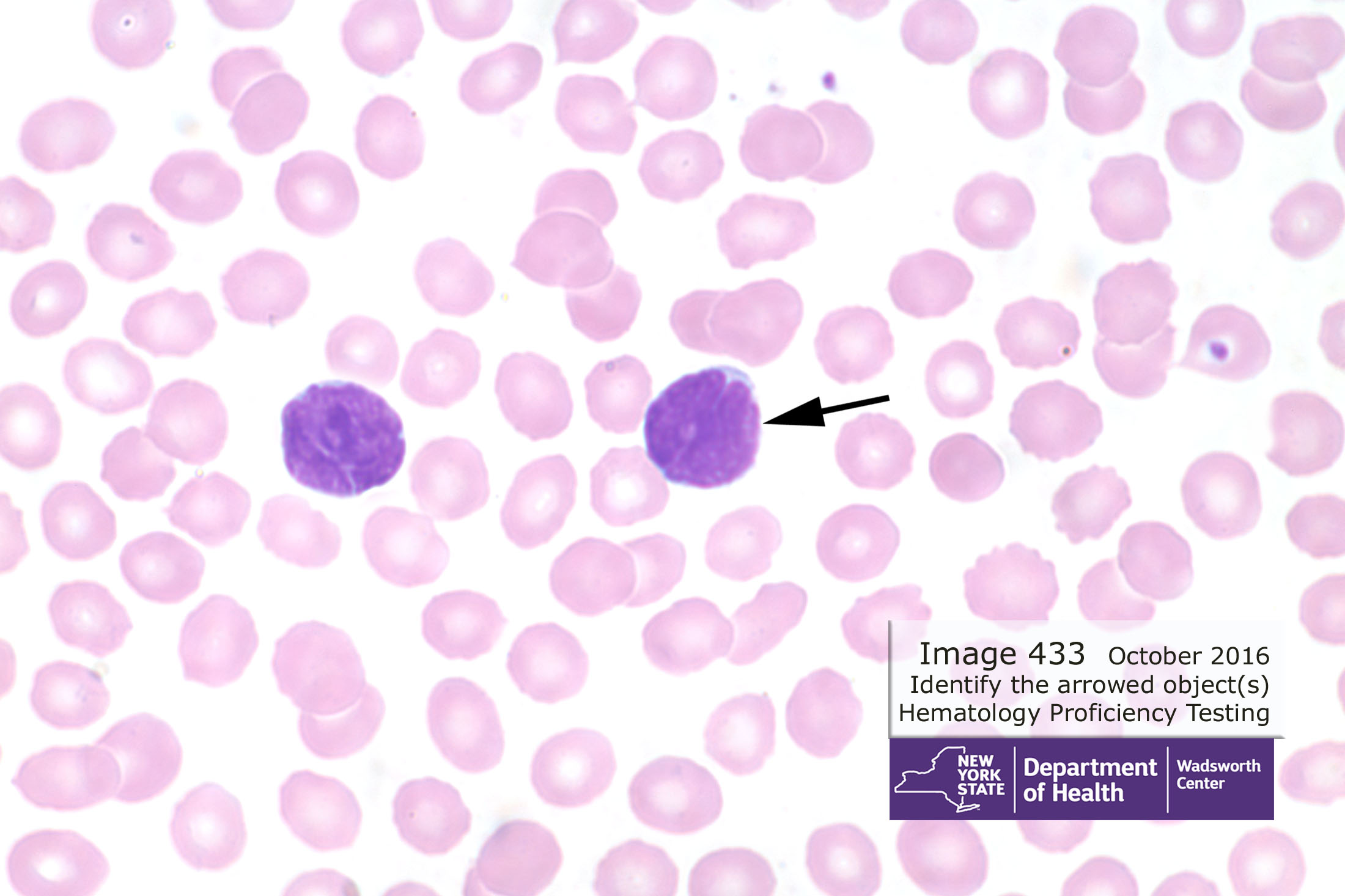 Hematology Image 433