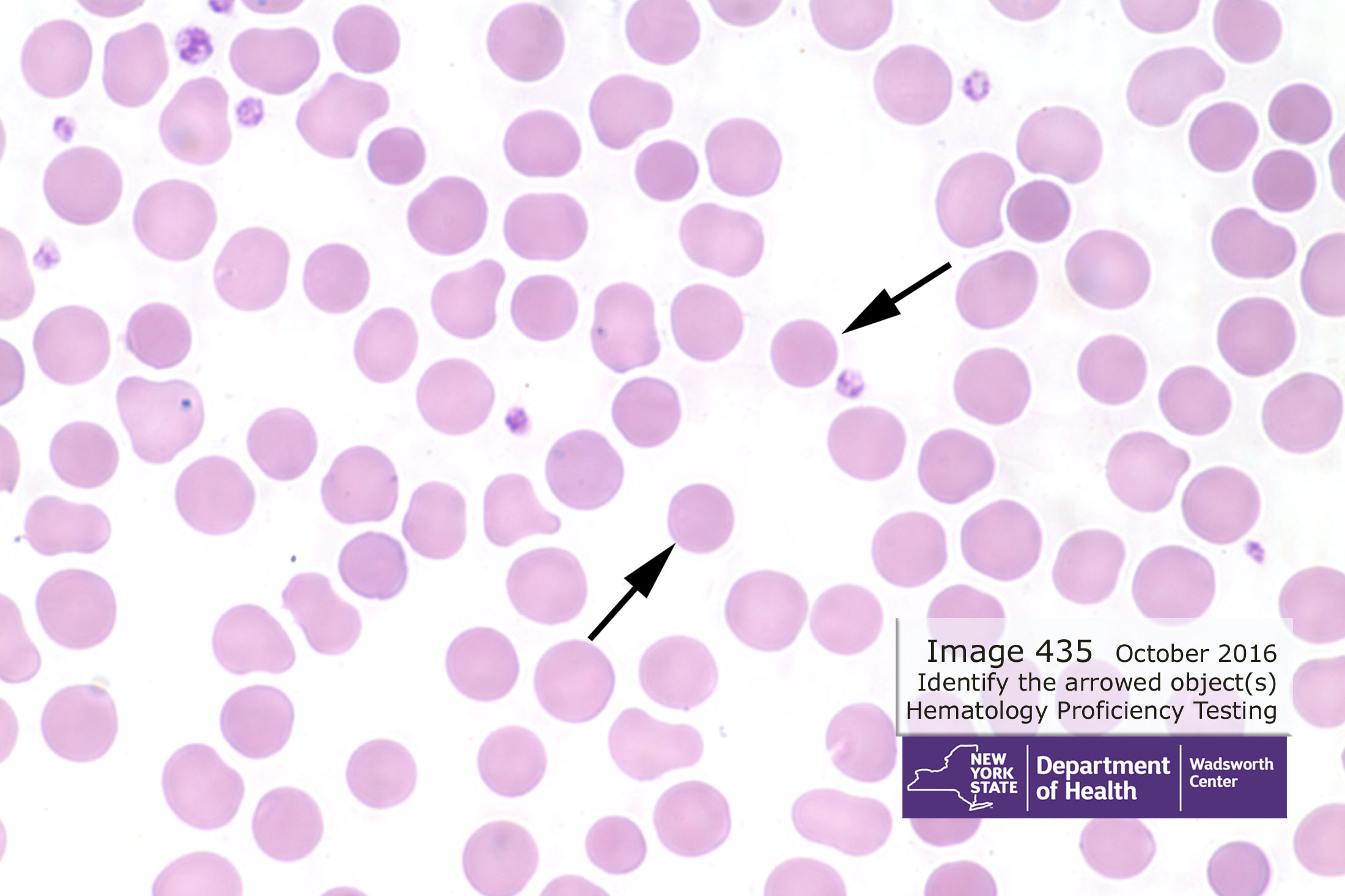 Hematology Image 435