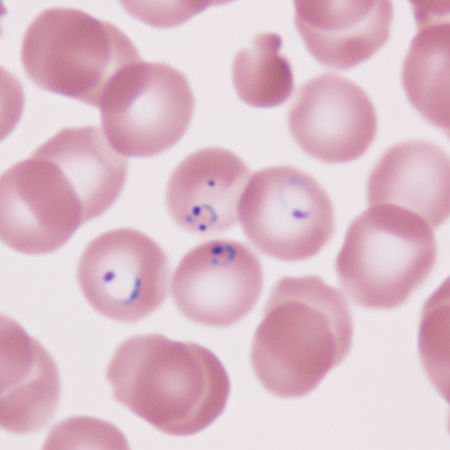 Ring form malaria parasites in red blood cells on a Giemsa-stained blood slide