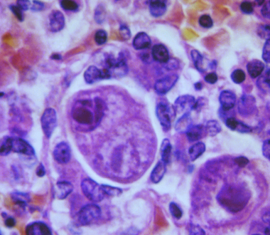 Cytomegalovirus in pituitary gland tissue magnified 500x. Photo credit: CDC