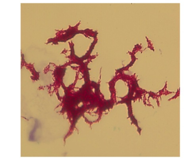 Corded TB acid fast stained by Ziehl-Neelsen method