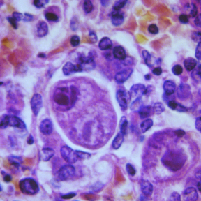 Newborn Screening Congenital Cytomegalovirus (cCMV) Pilot Study ...